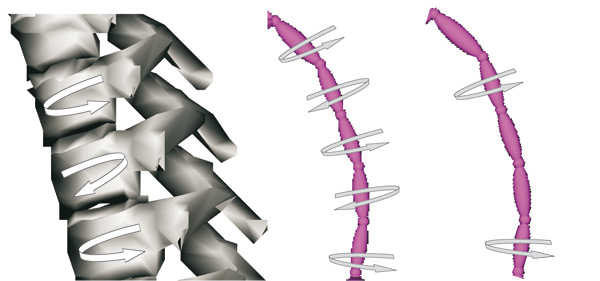 Possible changes of the torsion direction of vertebrae for an uncoupled spine (left) and corresponding measured values for uncoupled spine (middle) and coupled spine (right).