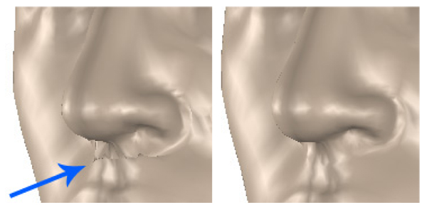 Effect of geometric regularization on a model with an overlap depth of one vertex. Left: A crease under the nose is clearly visible. Right: The same model fitted with geometric regularization.